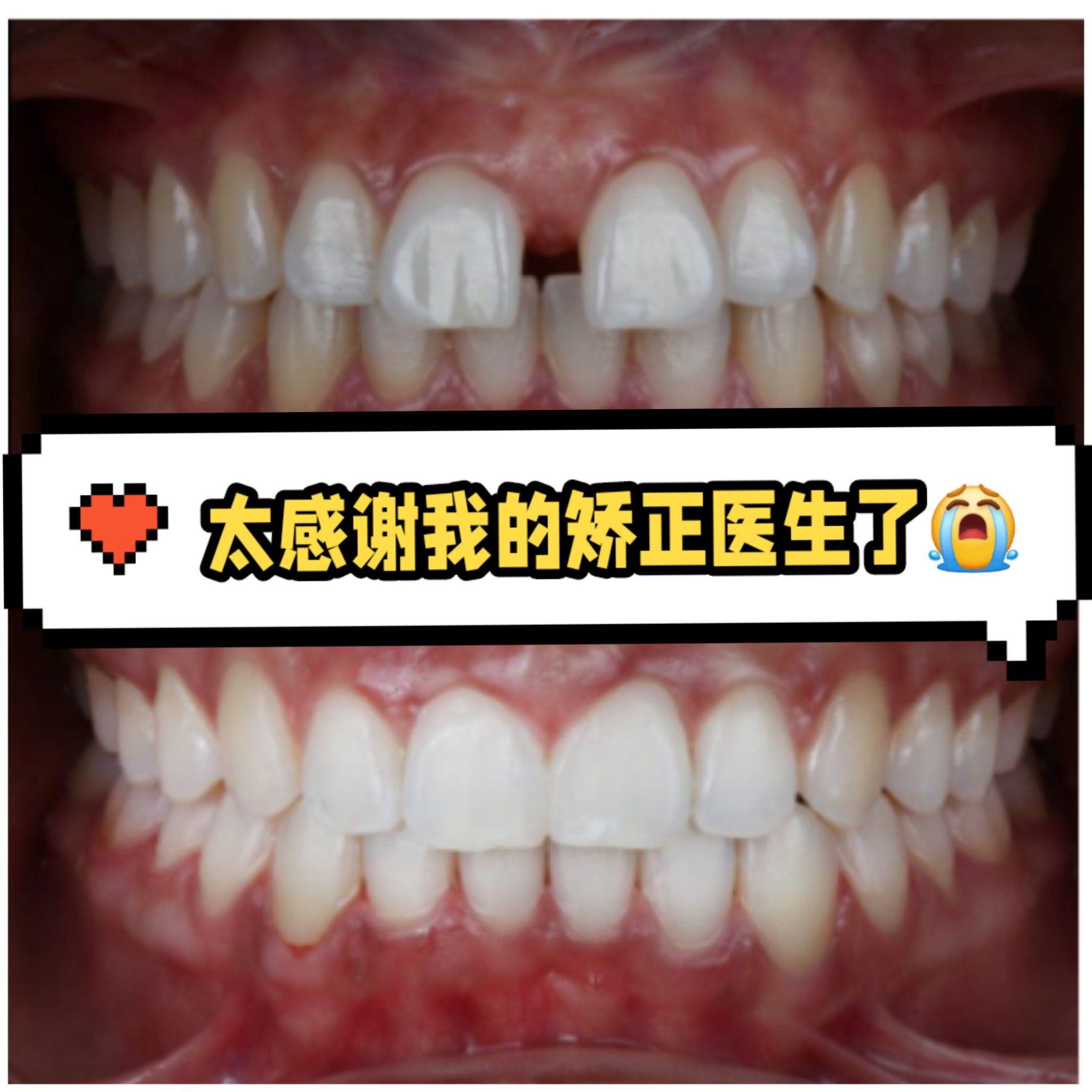 以前的门牙是外八字朝两边散开的😖,真的是没眼看啊