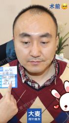 -大麦微针植发丨全国连锁