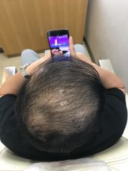 -大麦微针植发全国连锁