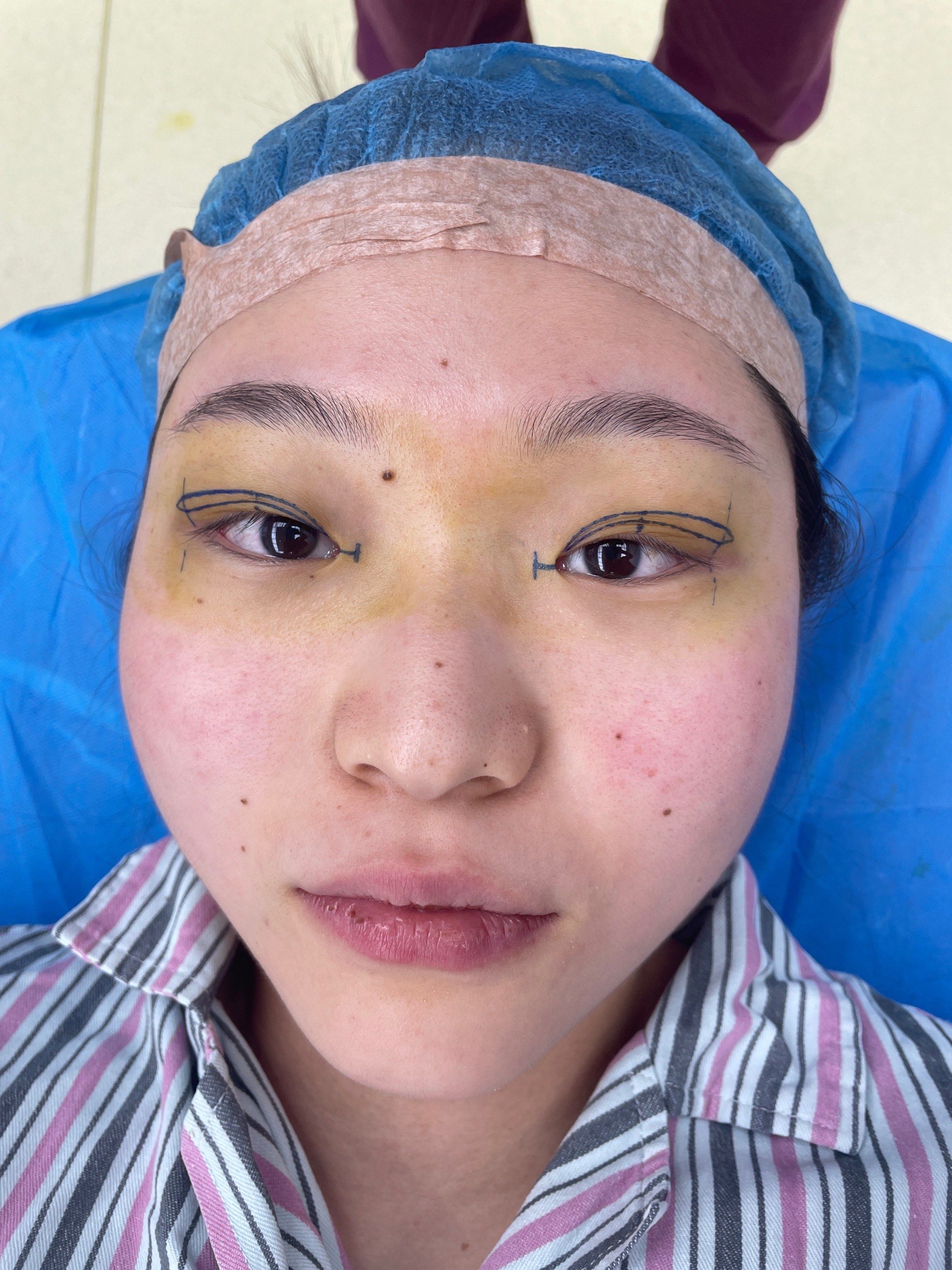 【梁雪1号作品@划线篇】做双眼皮手术为什么要划线?