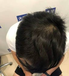 点击看大图 体验后-大麦微针植发丨全国连锁