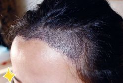 -大麦微针植发丨全国连锁