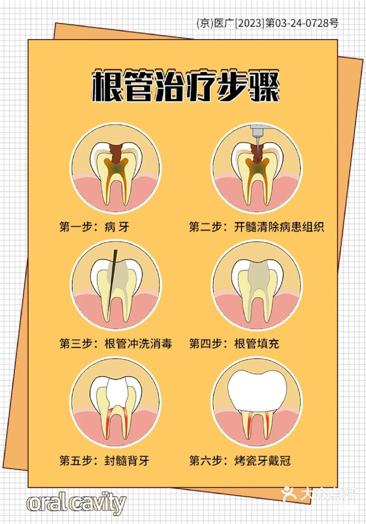 牙齿根管治疗步骤图图片