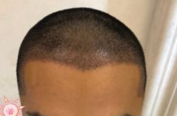 -大麦微针植发丨全国连锁