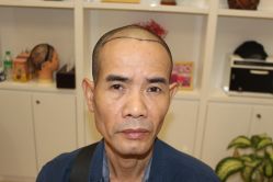 -大麦微针植发丨全国连锁