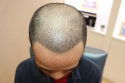 -大麦微针植发丨全国连锁