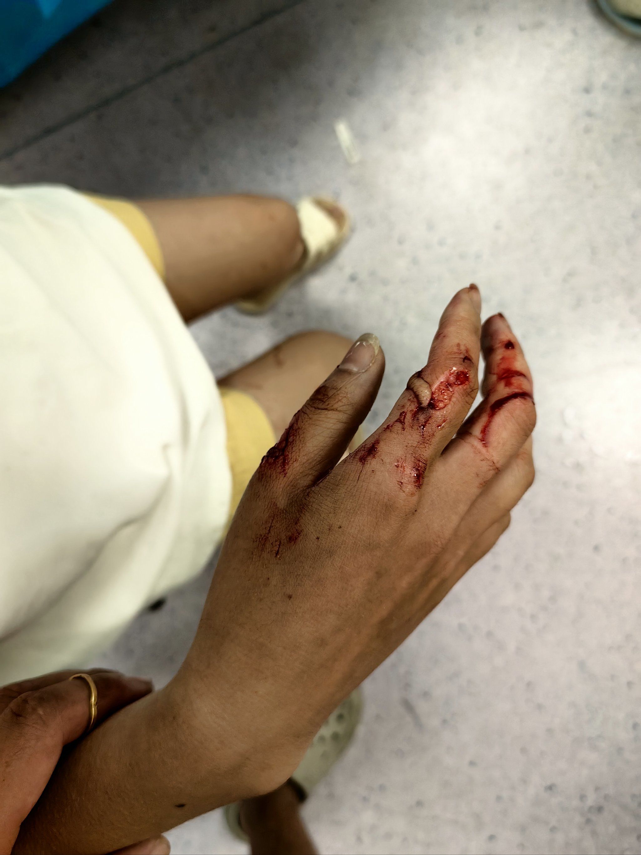 丹江口丽锦酒店四楼玻璃掉落砸伤客人,目前双手手指无法正常生活,酒店