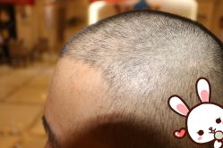 点击看大图 -大麦微针植发丨全国连锁