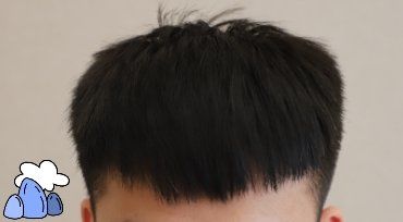 -大麦微针植发丨全国连锁