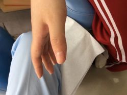 -德哥灰指甲脚气甲沟炎跖疣护理
