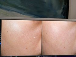 体验后-苑苑vbeauty科技美容SPA