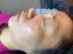 -美丽人生祛斑扁平疣汗管瘤中心