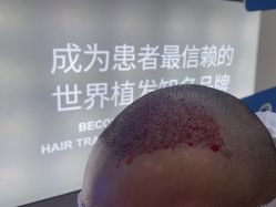 体验后-大麦微针植发全国连锁