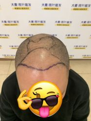 -大麦微针植发全国连锁