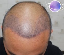 -大麦微针植发丨全国连锁