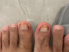 -世龙世家灰指甲鸡眼脚气甲沟炎跖疣护理(通州店)