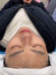 体验后-海涛医疗美容·面部抗衰·注射美鼻