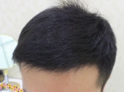 -大麦微针植发丨全国连锁