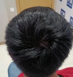 点击看大图 -大麦微针植发丨全国连锁
