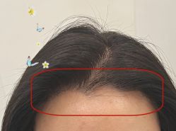 -大麦微针植发全国连锁