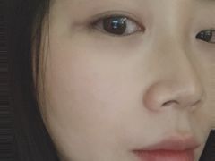 -黑马眼科·近视手术