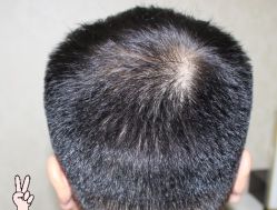 -大麦微针植发丨全国连锁