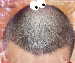 -大麦微针植发全国连锁