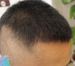 -大麦微针植发丨全国连锁