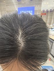 -大麦微针植发丨全国连锁