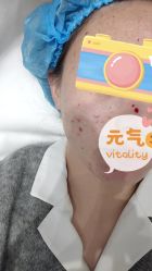 体验后-agge蛋白医美