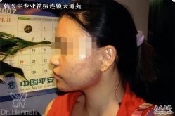 -韩医生专业祛痘连锁机构