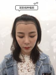 -大麦微针植发全国连锁
