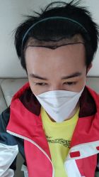 -大麦微针植发丨全国连锁