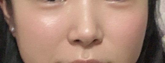 体验后-素美医疗美容·西南眼鼻整形·修复基地