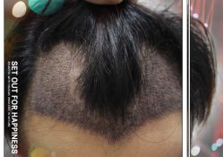 -大麦微针植发全国连锁