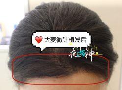 -大麦微针植发全国连锁