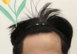 -大麦微针植发全国连锁