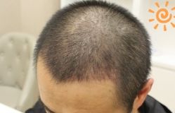 -大麦微针植发丨全国连锁