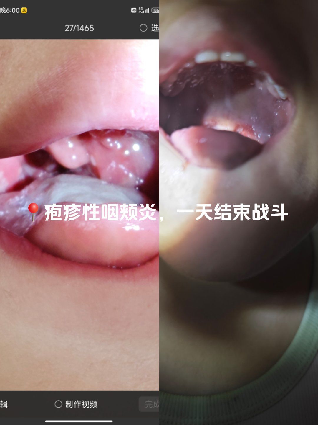 疱疹性咽颊炎,一天消泡,就是这么神奇