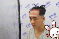 -大麦微针植发丨全国连锁