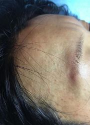 体验前-爱莎扁平疣·汗管瘤·斑痣中心