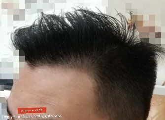 -大麦微针植发丨全国连锁