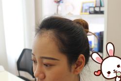 点击看大图 -大麦微针植发丨全国连锁