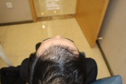 -大麦微针植发丨全国连锁