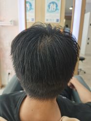 -大麦微针植发丨全国连锁