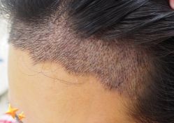 -大麦微针植发丨全国连锁