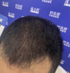 -碧莲盛·不剃发植发