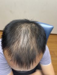 -大麦微针植发全国连锁