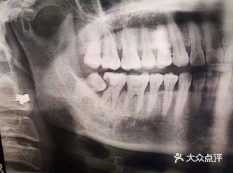 关于智齿你必须知道的事