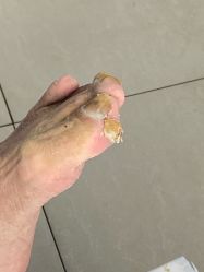 -德哥灰指甲脚气甲沟炎跖疣护理